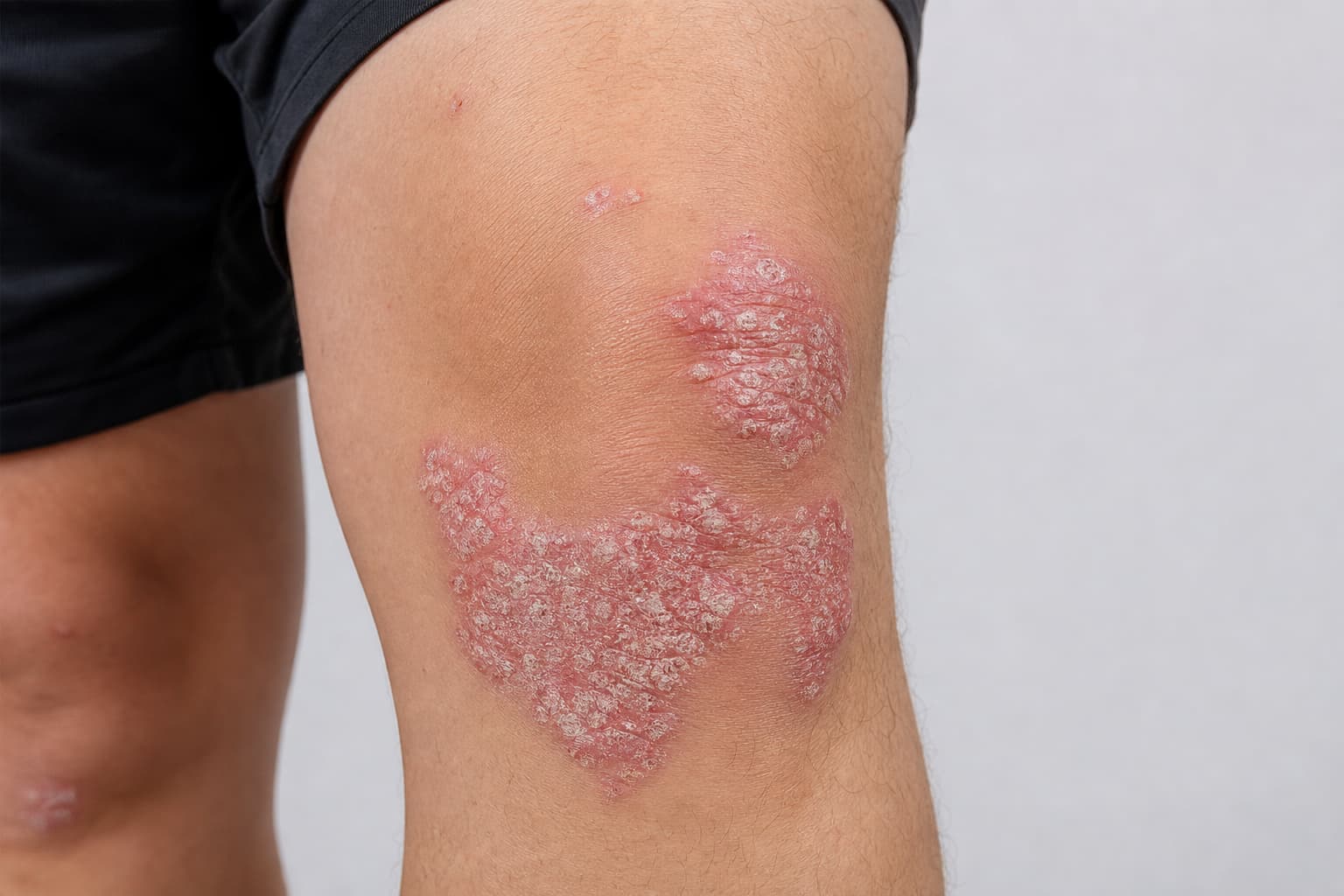 Hvad er psoriasis? Forstå tilstanden
